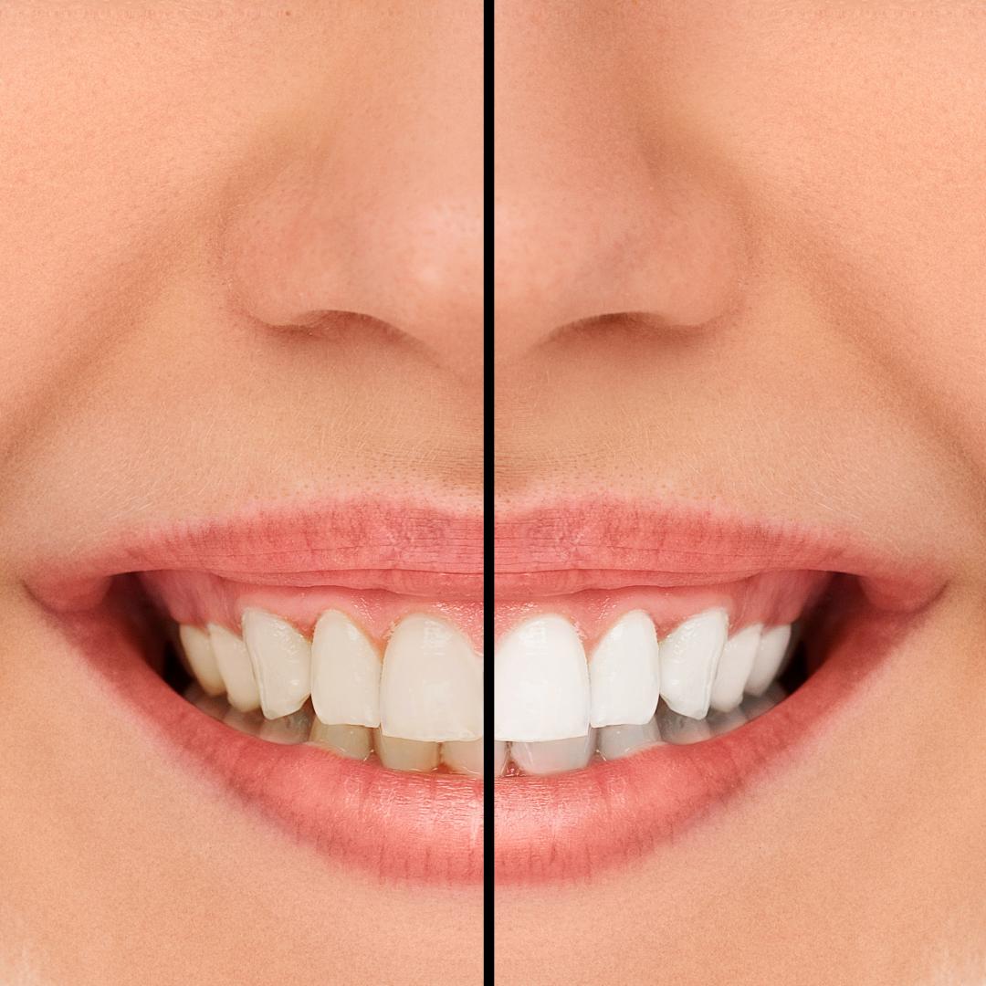 Beautiful Smile Teeth Whitening Treatment