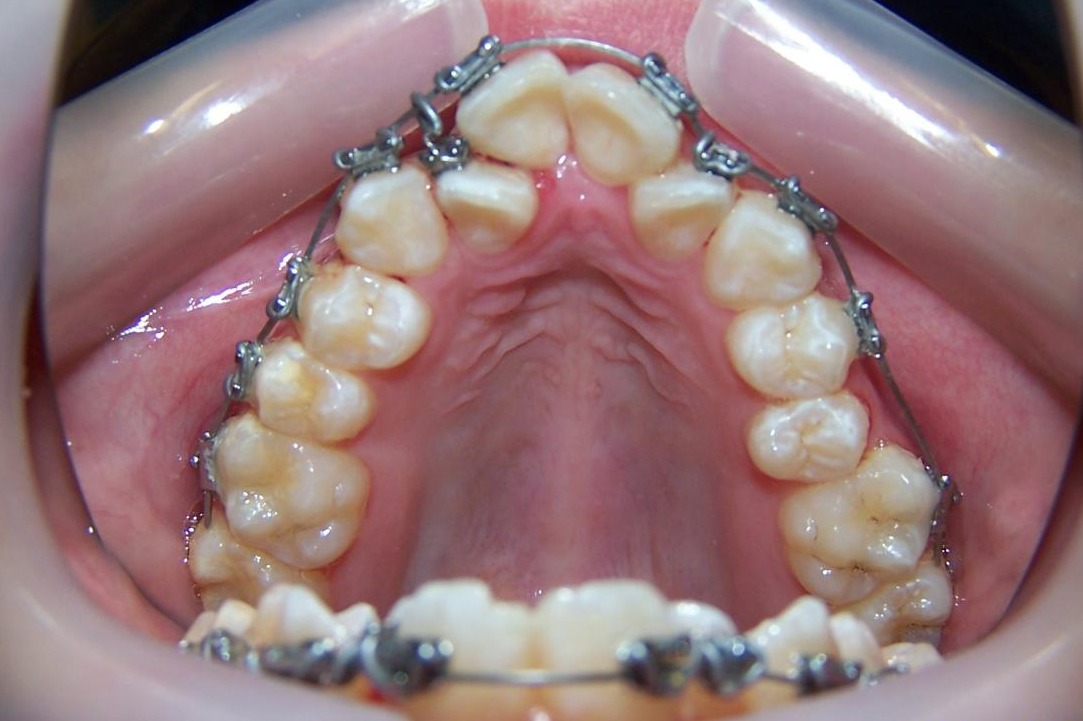 Transformative Dental Braces Treatment
