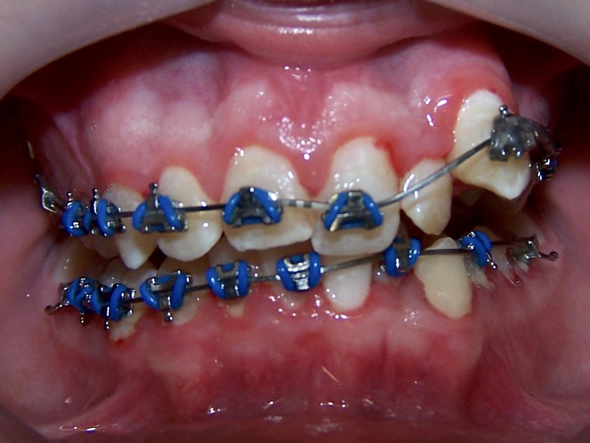 Transformative Dental Braces Treatment