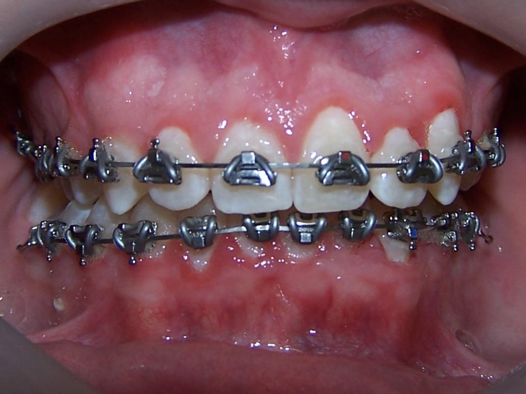 Stunning Dental Braces And Retainers